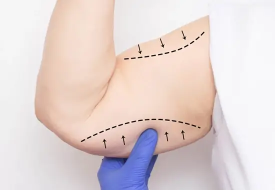 Les Avantages du Lifting Bras en Tunisie